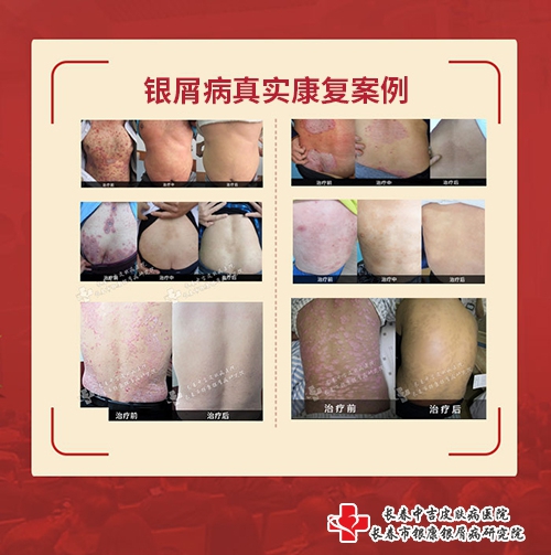 长春中吉皮肤病医院银屑病康复案例 长春中吉皮肤病医院银屑病康复案例