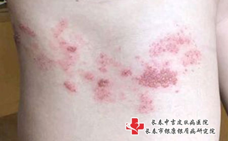 带状疱疹有哪些症状? 带状疱疹有哪些症状?