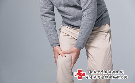 牛皮癣的危害后果是什么？通常如何治疗牛皮癣？