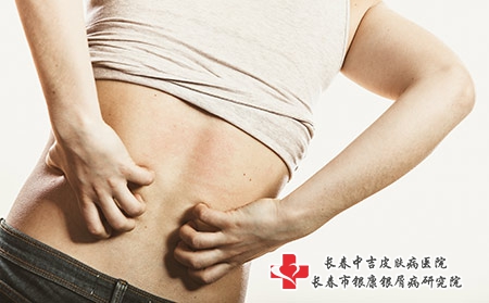 头皮牛皮癣能治好吗?参地肤康丸开水送服吗 头皮牛皮癣能治好吗?参地肤康丸开水送服吗