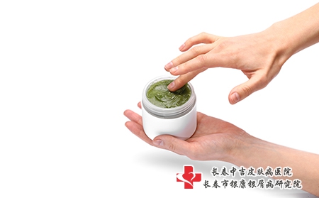 治疗牛皮癣的简单方法