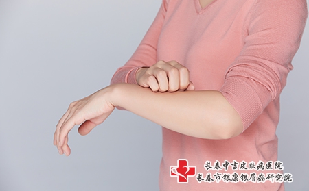 三八女人节,牛皮癣防护要做好 三八女人节,牛皮癣防护要做好