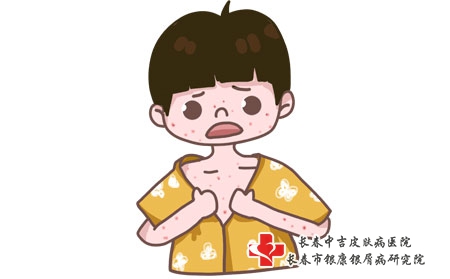 青年人牛皮癣预防方法有哪些