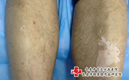 治疗白癜风的医院应满足什么什么标准