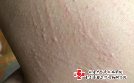 西医哪些药物可以治疗荨麻疹