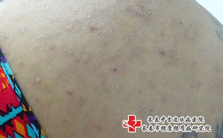 临床上股癣和湿疹的区别是什么