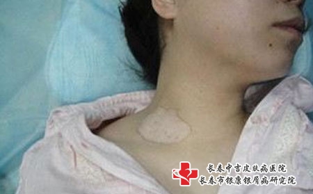疫情期间白癜风患者应注意什么