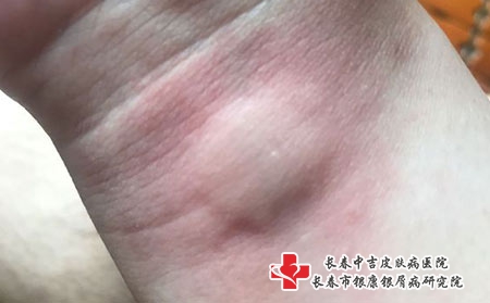 疫情期间为何无缘无故患上了荨麻疹