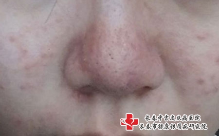 疫情期间酒糟鼻更严重了怎么办