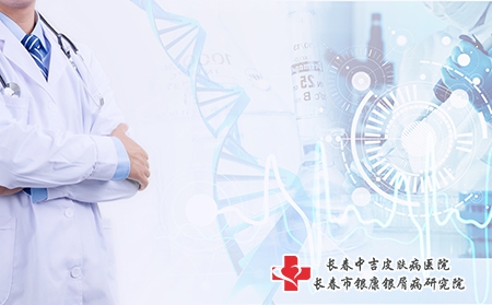 牛皮癣应该如何治疗呢