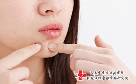 女性脸上有牛皮癣该如何护理 女性脸上有牛皮癣该如何护理