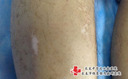 如何治疗白癜风才会防止复发