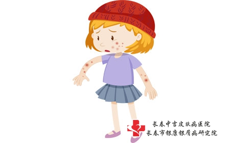 孩子脸上长了牛皮癣该怎么治
