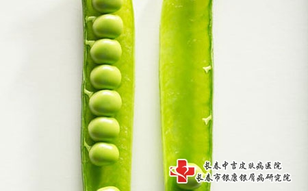 长春中吉皮肤病医院：青少年牛皮癣应该怎么治?