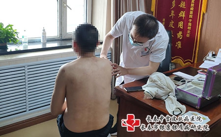 长春皮肤医院地址-长春什么方法能治银屑病 长春皮肤医院地址-长春什么方法能治银屑病