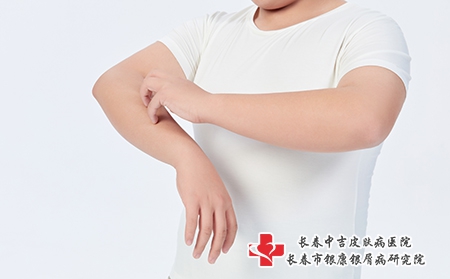 摄图网_501687661_青少年儿童皮肤瘙痒（企业商用）