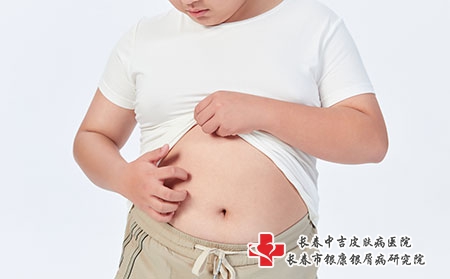 摄图网_501687663_青少年儿童皮肤瘙痒（企业商用）