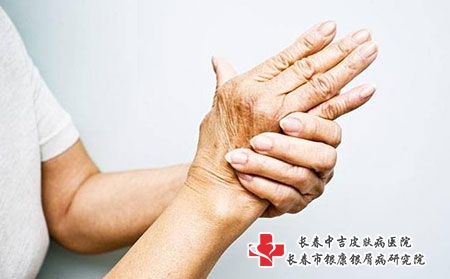 夏季牛皮癣患者需要特别关注哪些方面?