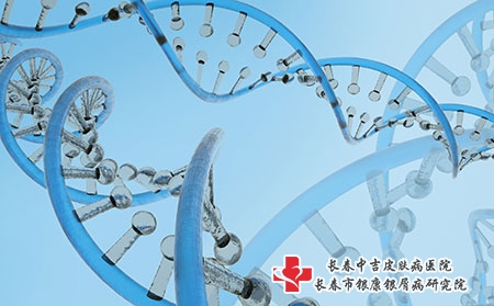 银屑病可以治疗好吗?有什么治疗方法