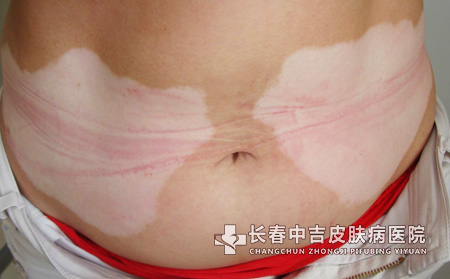 白癜风临床症状