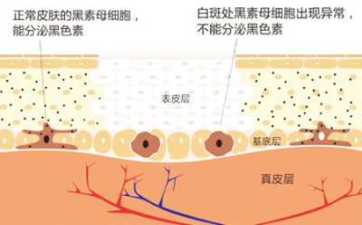 白癜风治疗方法