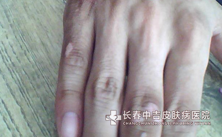 不易治疗白癜风的原因
