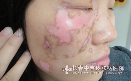 什么药在生活中能治白癜风