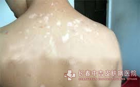 治白癜风究竟要多少钱呢