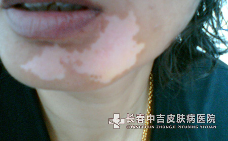 治疗白癜风的合适药物有什么