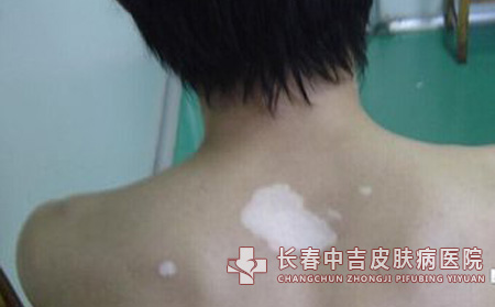 哪种药物治疗白癜风的效果会更合适