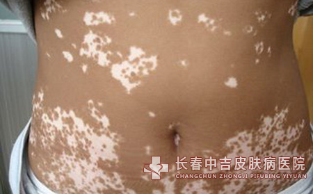 白癜风药物