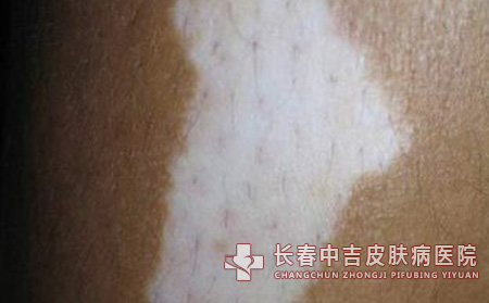 白癜风药物
