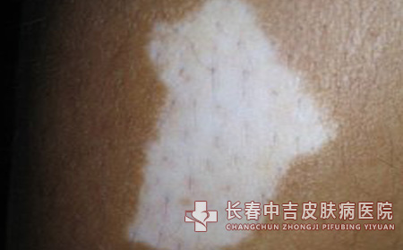 白癜风药物