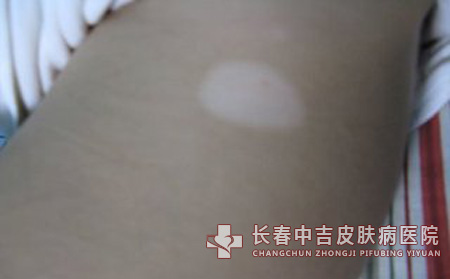 白癜风药物