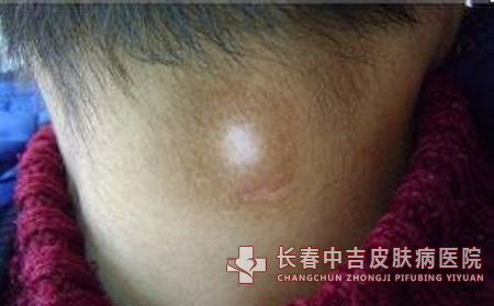 白癜风症状