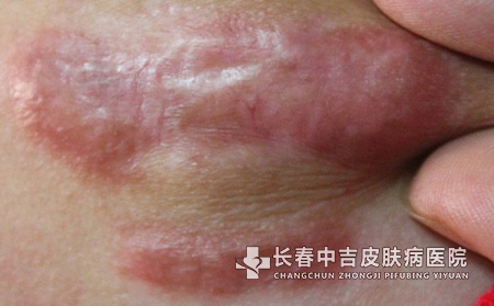 疤痕的特征及危害