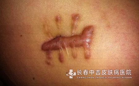 疤痕的类型