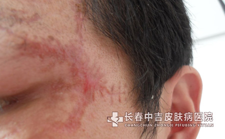 怎样消除疤痕的刺痒症状？