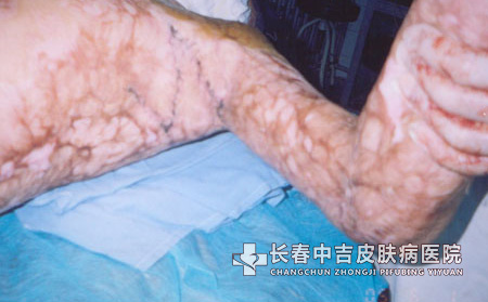 疤痕疙瘩有怎样的症状特点