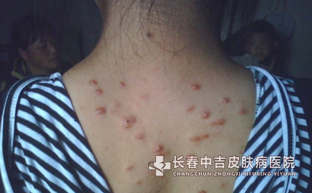 痤疮疤痕的临床表现