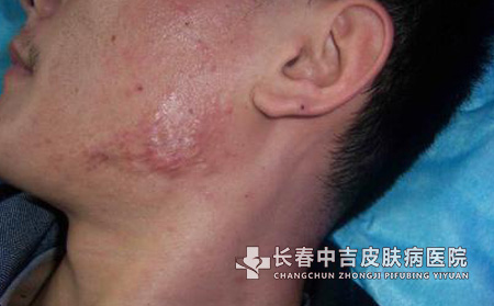 痤疮疤痕的症状有哪些？