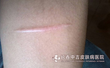 疤痕护理