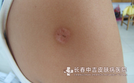 疤痕护理