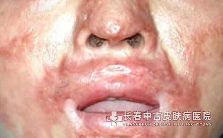康瑞保治疗瘢痕效果怎么样