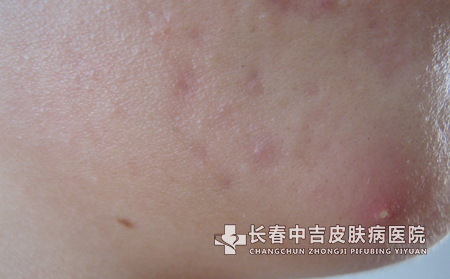 痤疮的临床症状