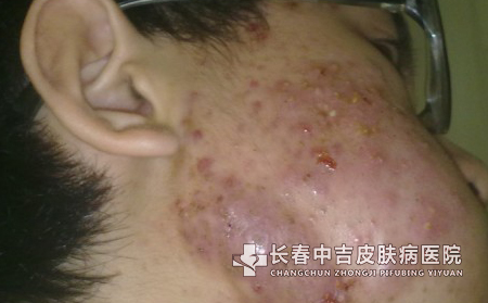 介绍痤疮的症状