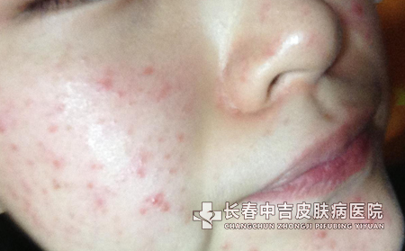 常见的痤疮的症状会有哪些表现呢？