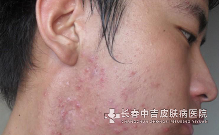 痤疮有哪些症状?