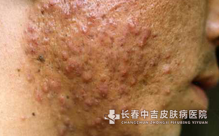 痤疮的症状有哪些