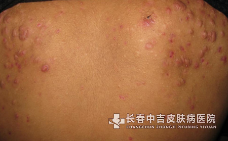 疤痕预防